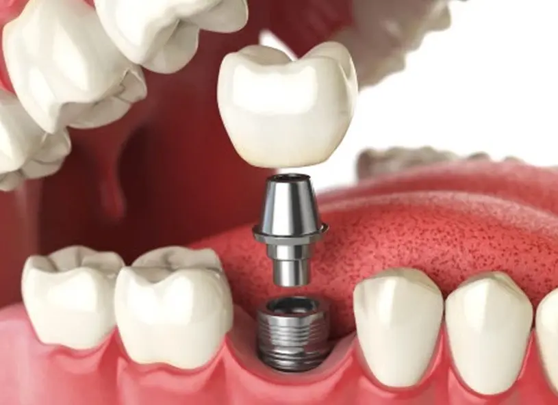 Implantes unitários