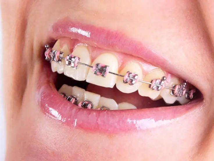 Ortodontia Convencional