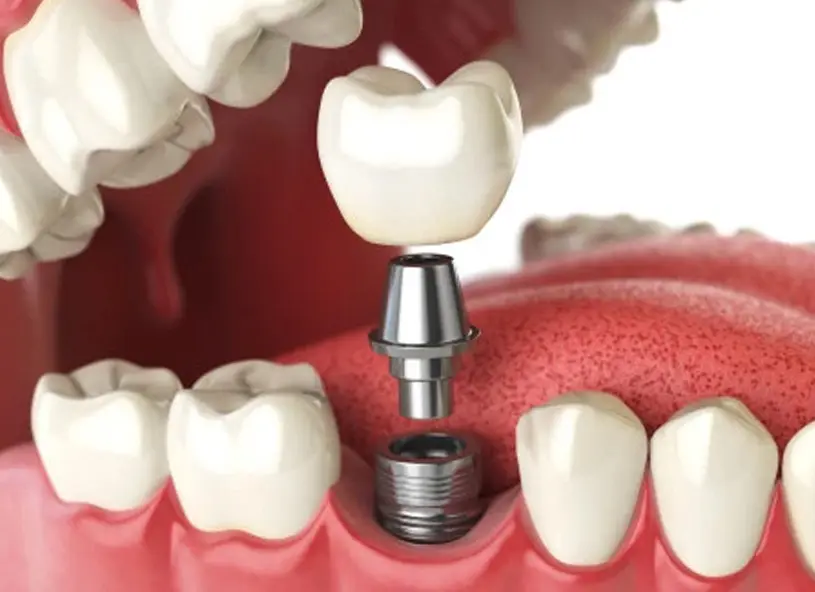 Paciente sorrindo após reabilitação oral com implantes