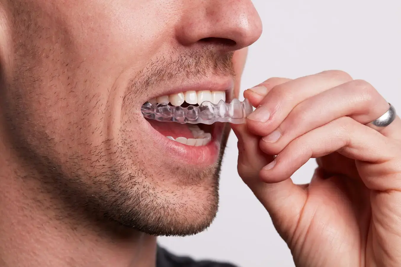 Paciente sorrindo após controle do bruxismo