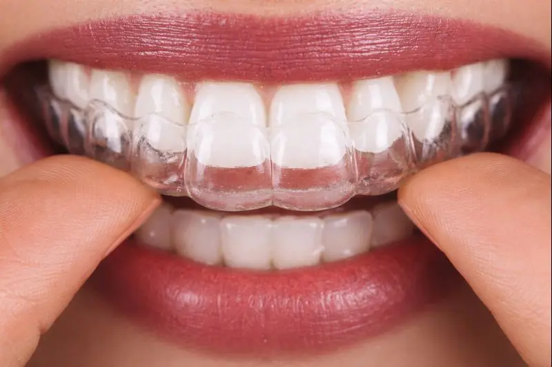 Ortodontia com Alinhadores
