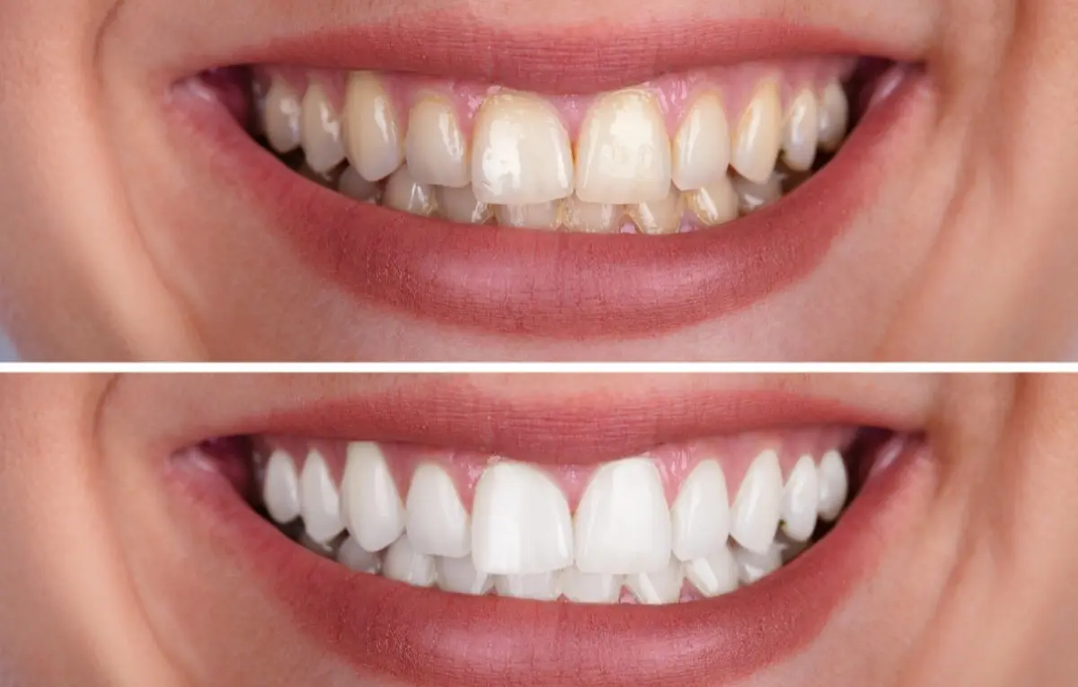 Paciente sorrindo após clareamento dental