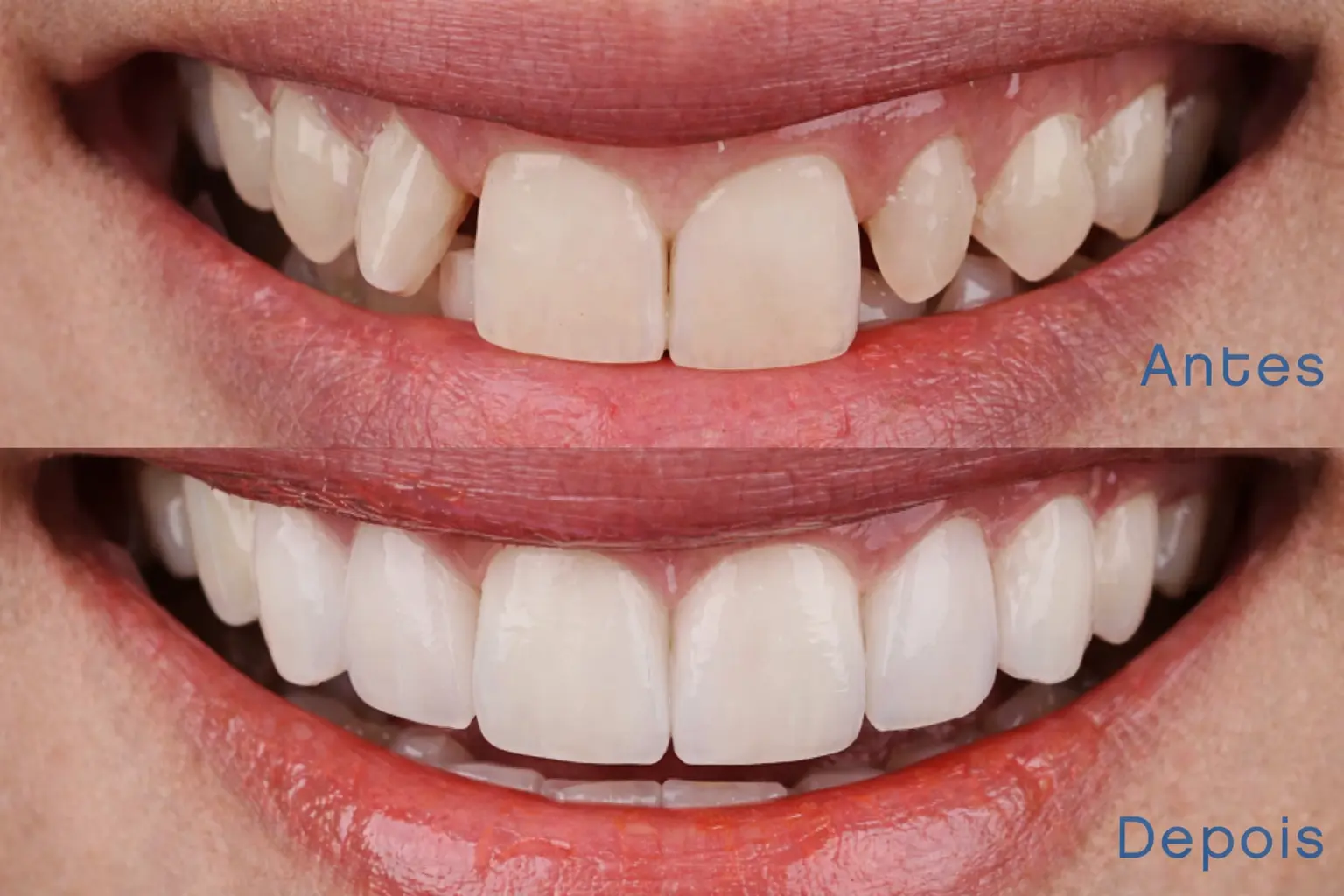 Paciente sorrindo após aplicação de facetas em resina