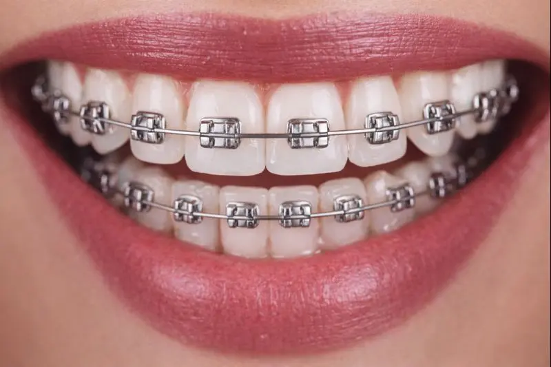 Ortodontia Convencional