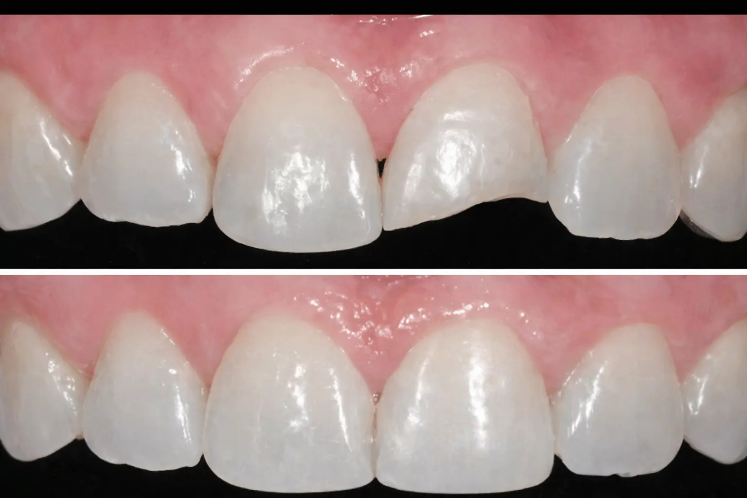 Profissional realizando restauração dental em paciente