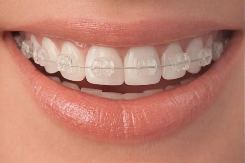 Ortodontia Estética